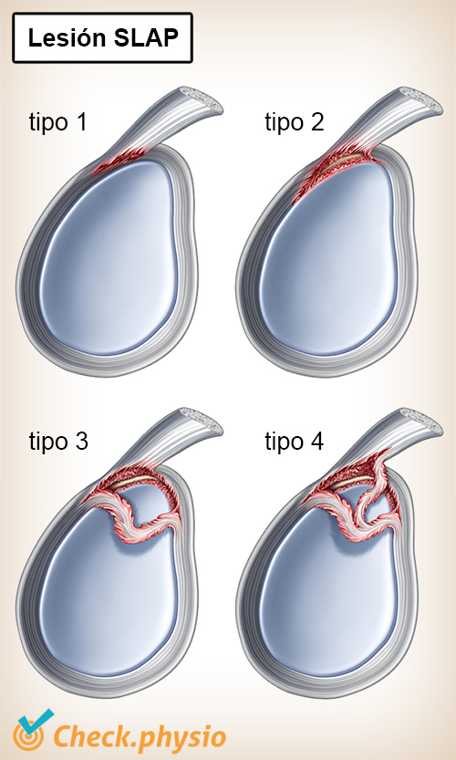 Causa S ntomas Y Tratamiento Lesi n SLAP Physiocheck co